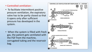 • Controlled ventilation : 
• To facilitate intermittent positive 
pressure ventilation, the expiratory 
valve has to be partly closed so that 
it opens only after sufficient 
pressure has developed in the 
system. 
• When the system is filled with fresh 
gas, the patient gets ventilated with 
the FGF from the machine, 
corrugated tubing and the reservoir 
bag. 
 