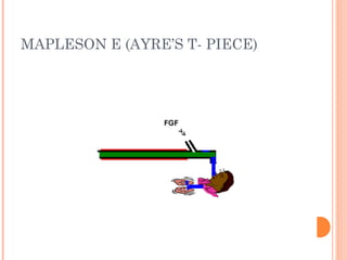 MAPLESON E (AYRE’S T- PIECE) 
 
