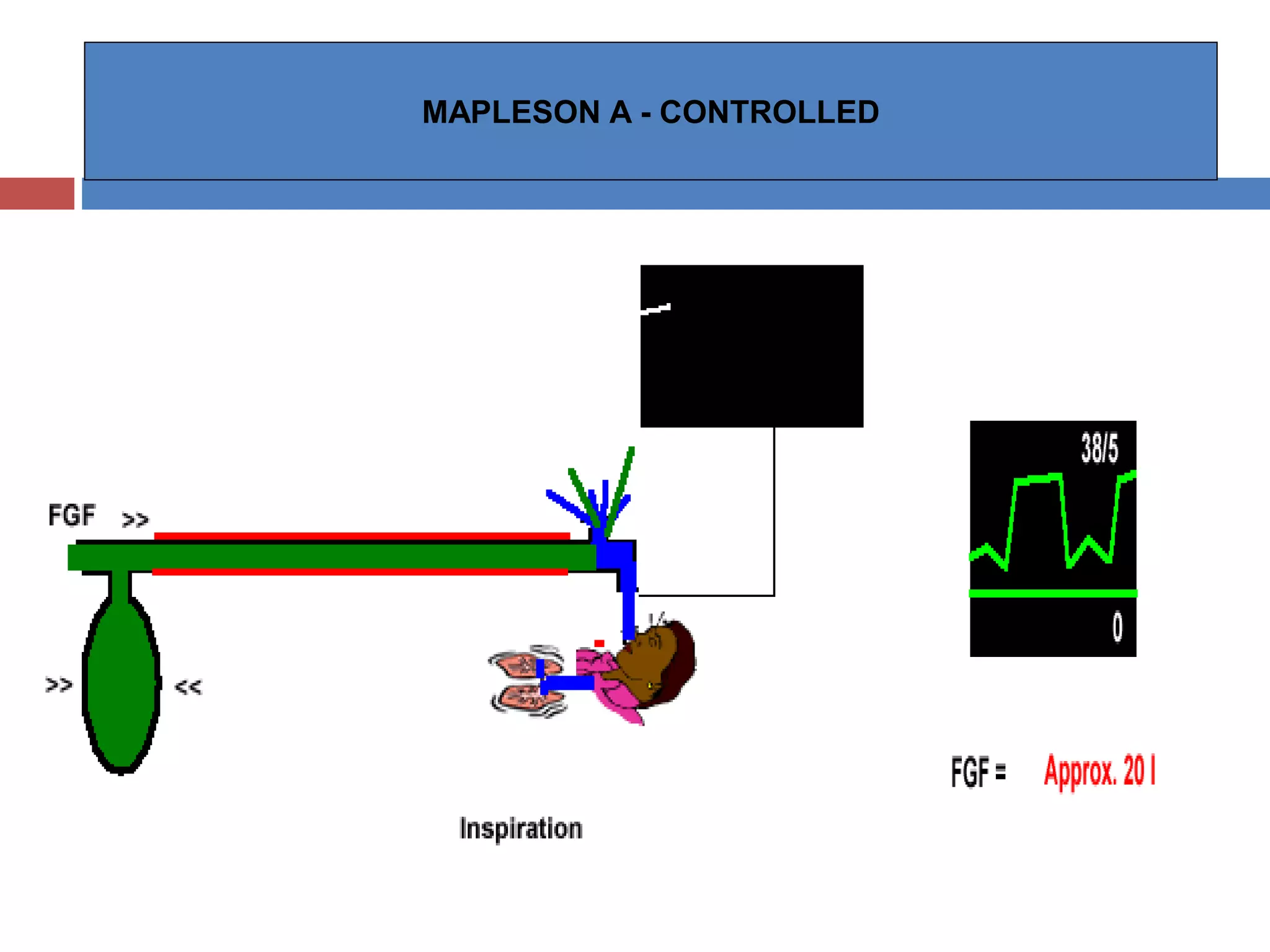 MAPLESON A - CONTROLLED
 