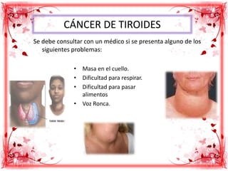 CÁNCER DE TIROIDES
Se debe consultar con un médico si se presenta alguno de los
siguientes problemas:
• Masa en el cuello.
• Dificultad para respirar.
• Dificultad para pasar
alimentos
• Voz Ronca.
 