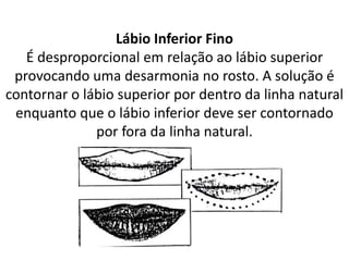 Lábio Inferior Fino
É desproporcional em relação ao lábio superior
provocando uma desarmonia no rosto. A solução é
contornar o lábio superior por dentro da linha natural
enquanto que o lábio inferior deve ser contornado
por fora da linha natural.
 
