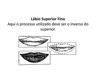 Lábio Superior Fino
Aqui o processo utilizado deve ser o inverso do
superior.
 