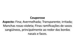 Couperose
Aspecto: Fina; Avermelhada; Transparente; irritada;
Manchas rosas-violeta; Finas ramificações de vasos
sangüíneos, principalmente ao redor das bordas
nasais e faces.
 