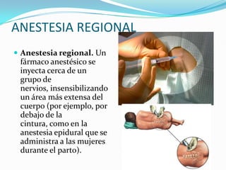 ANESTESIA REGIONAL
 Anestesia regional. Un
 fármaco anestésico se
 inyecta cerca de un
 grupo de
 nervios, insensibilizando
 un área más extensa del
 cuerpo (por ejemplo, por
 debajo de la
 cintura, como en la
 anestesia epidural que se
 administra a las mujeres
 durante el parto).
 