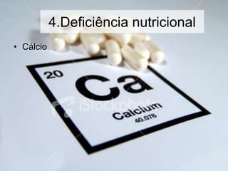 4.Deficiência nutricional
• Cálcio
 