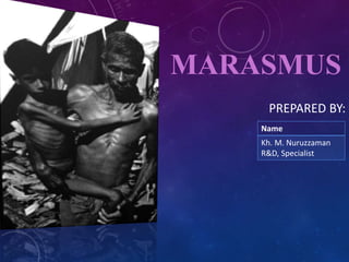 MARASMUS
PREPARED BY:
Name
Kh. M. Nuruzzaman
R&D, Specialist
 