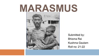 MARASMUS
Submitted by:
Bhisma Rai
Kushma Gautam
Roll no: 21-22
 