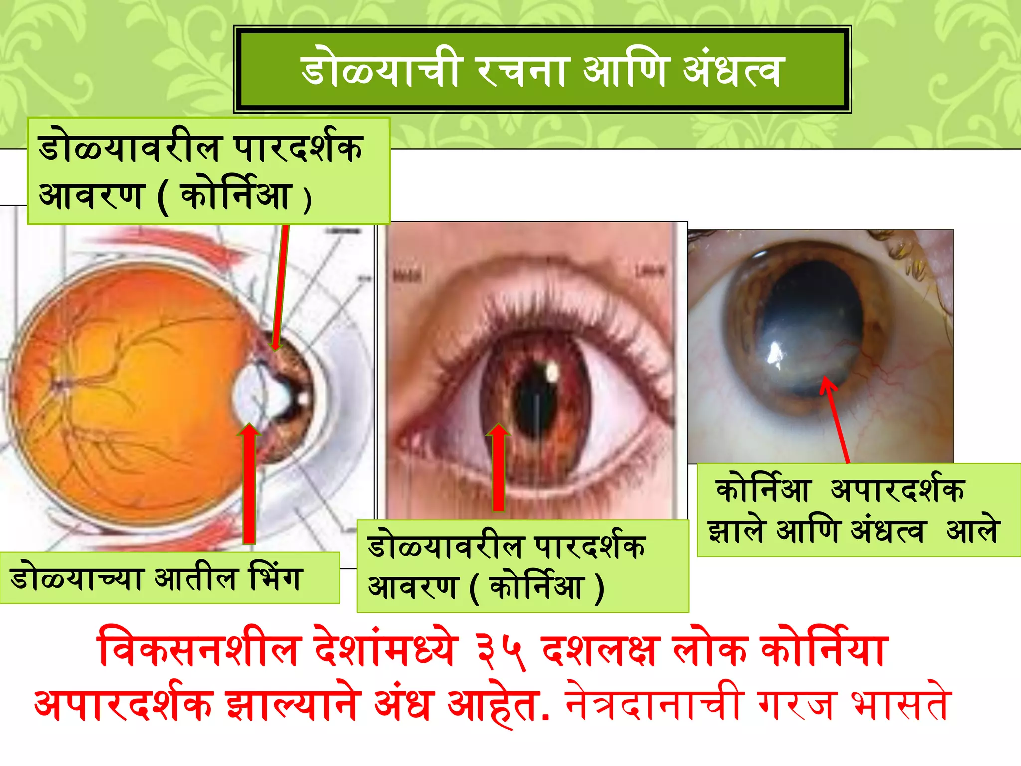 डोळ्याची रचना आलण अुंधत्व
कोर्षनआ अपारदिशक
झािे आलण अुंधत्व आिे
लवकसनिीि देिाुं्ध्ये ३५ दििक्ष िोक कोर्षनया
अपारदिशक झाल्याने अुंध आहेत. नेत्रदानाची गरि भासते
डोळ्यावरीि पारदिशक
आवरण ( कोर्षनआ )
डोळ्यावरीि पारदिशक
आवरण ( कोर्षनआ )
डोळ्याच्या आतीि पभग