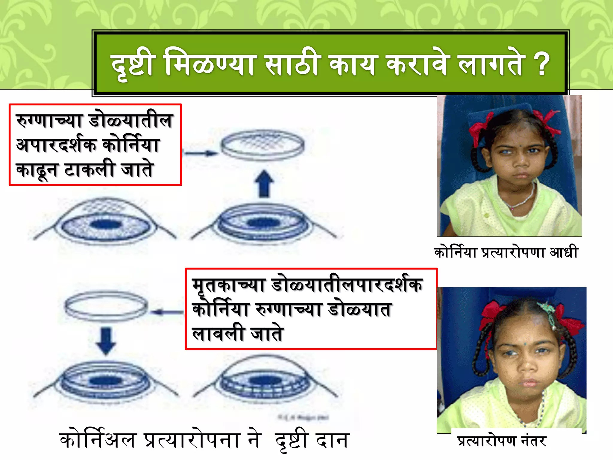 रुग्णाच्या डोळ्यातीि
अपारदिशक कोर्षनया
काढून टाकिी िाते
्ृतकाच्या डोळ्यातीिपारदिशक
कोर्षनया रुग्णाच्या डोळ्यात
िाविी िाते
कोर्षनया प्रत्यारोपणा आधी
प्रत्यारोपण नुंतरकोर्षनअि प्रत्यारोपना ने दृिी दान
