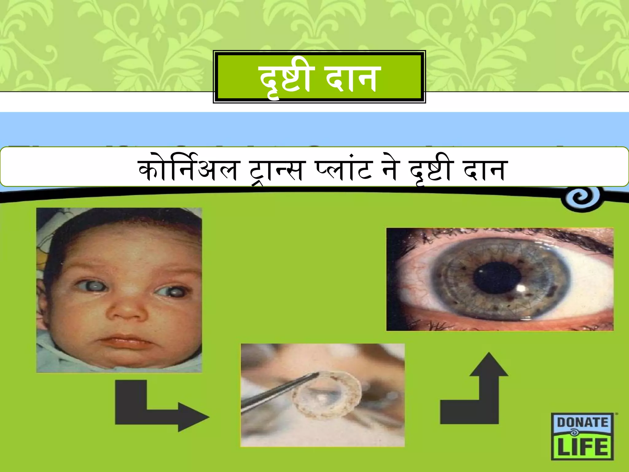 दृिी दान
कोर्निअल
कोर्षनअि ट्रानस पिाुंट ने दृिी दान