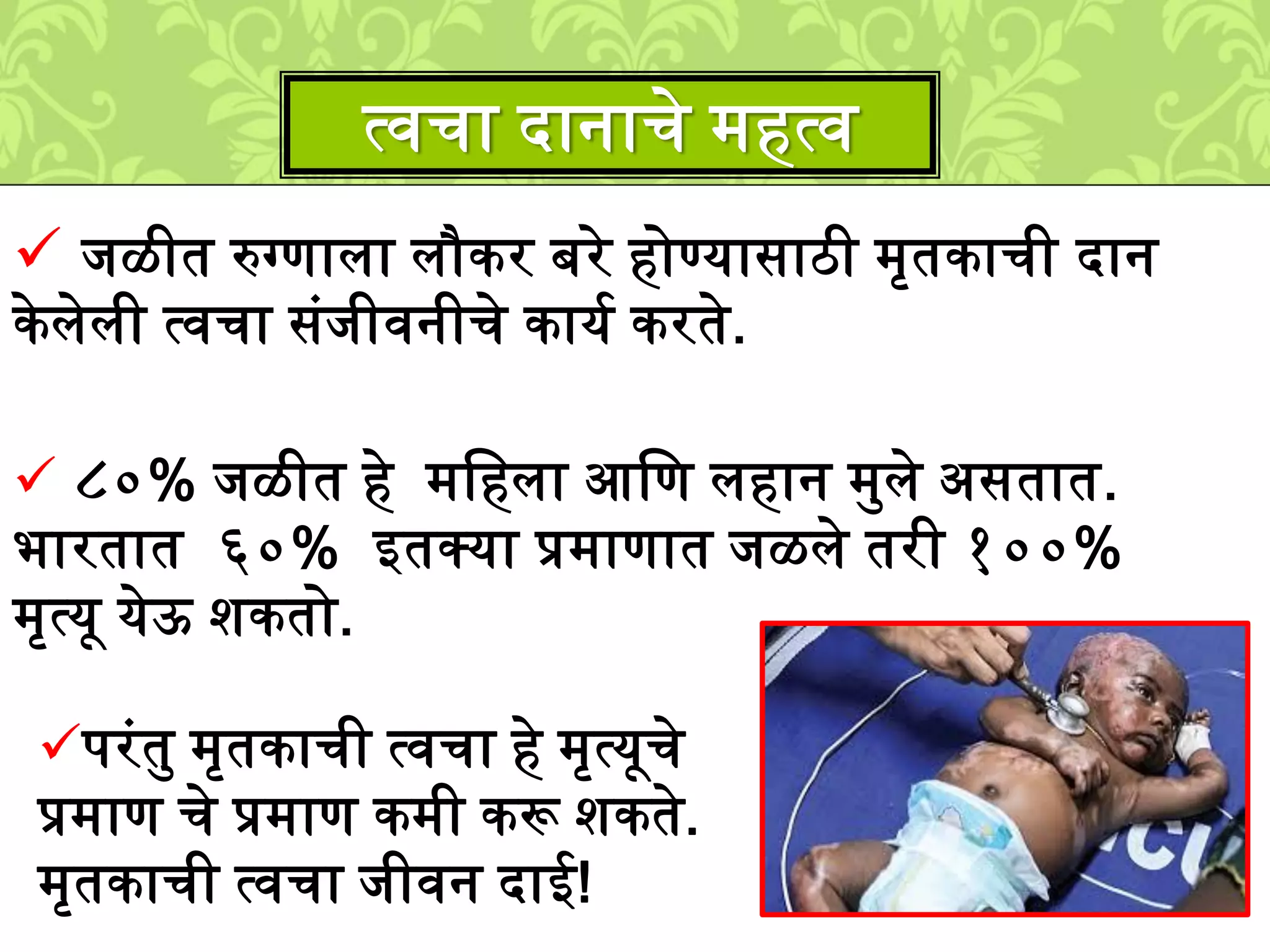  िळीत रुग्णािा िौकर बरे होण्यासाठी ्ृतकाची दान
के िेिी त्वचा सुंिीवनीचे कायश करते.
८०% िळीत हे ्लहिा आलण िहान ्मिे असतात.
भारतात ६०% इतक्या प्र्ाणात िळिे तरी १००%
्ृत्यू येऊ िकतो.
त्वचा दानाचे ्हत्व
परुंतम ्ृतकाची त्वचा हे ्ृत्यूचे
प्र्ाण चे प्र्ाण क्ी करू िकते.
्ृतकाची त्वचा िीवन दाई!