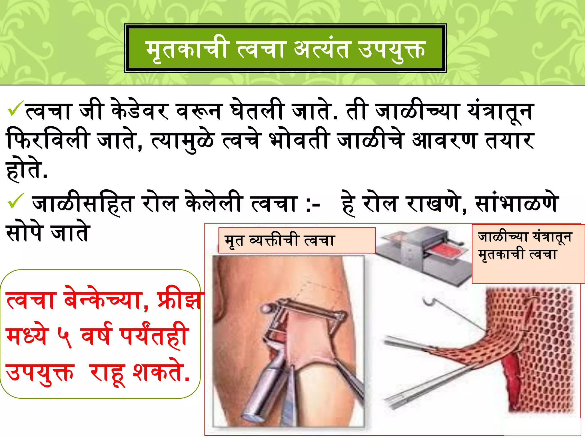 त्वचा िी के डेवर वरून घेतिी िाते. ती िाळीच्या युंत्रातून
कफरलविी िाते, त्या्मळे त्वचे भोवती िाळीचे आवरण तयार
होते.
िाळीसलहत रोि के िेिी त्वचा :- हे रोि राखणे, साुंभाळणे
सोपे िाते
त्वचा बेनके च्या, फ्रीझर
्ध्ये ५ विश पयांतही
उपयमक्त राहू िकते.
्ृतकाची त्वचा अत्युंत उपयमक्त
िाळीच्या युंत्रातून
्ृतकाची त्वचा
्ृत व्यक्तीची त्वचा