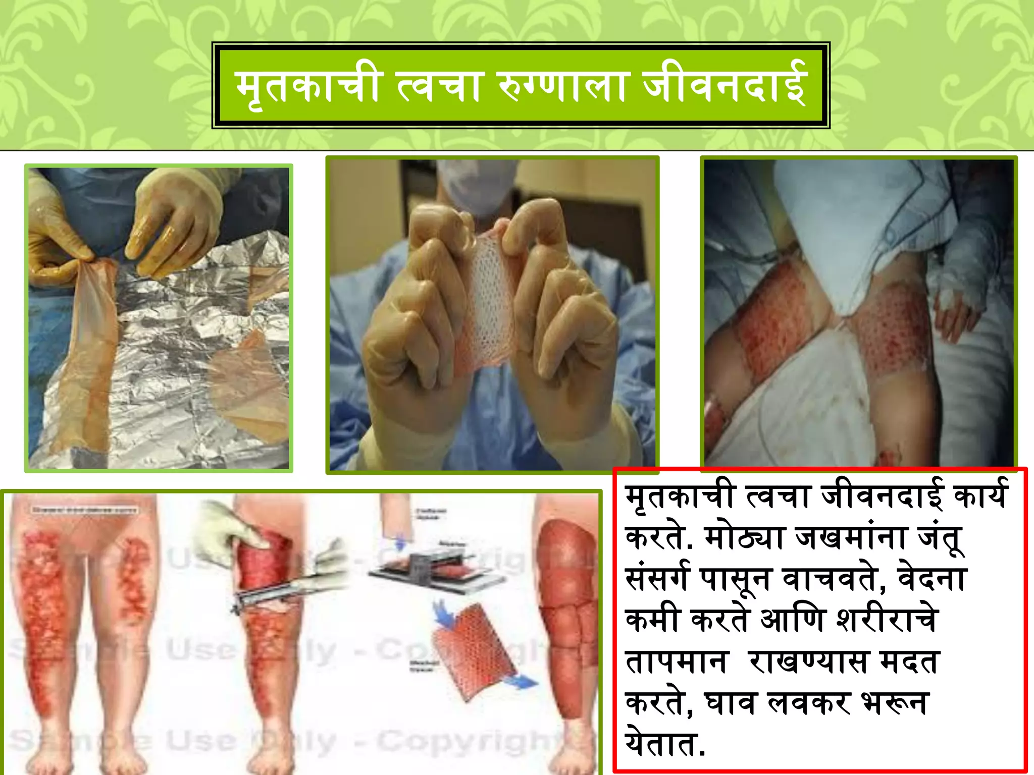 ्ृतकाची त्वचा रुग्णािा िीवनदाई
्ृतकाची त्वचा िीवनदाई कायश
करते. ्ोठ्या िख्ाुंना िुंतू
सुंसगश पासून वाचवते, वेदना
क्ी करते आलण िरीराचे
ताप्ान राखण्यास ्दत
करते, घाव िवकर भरून
येतात.