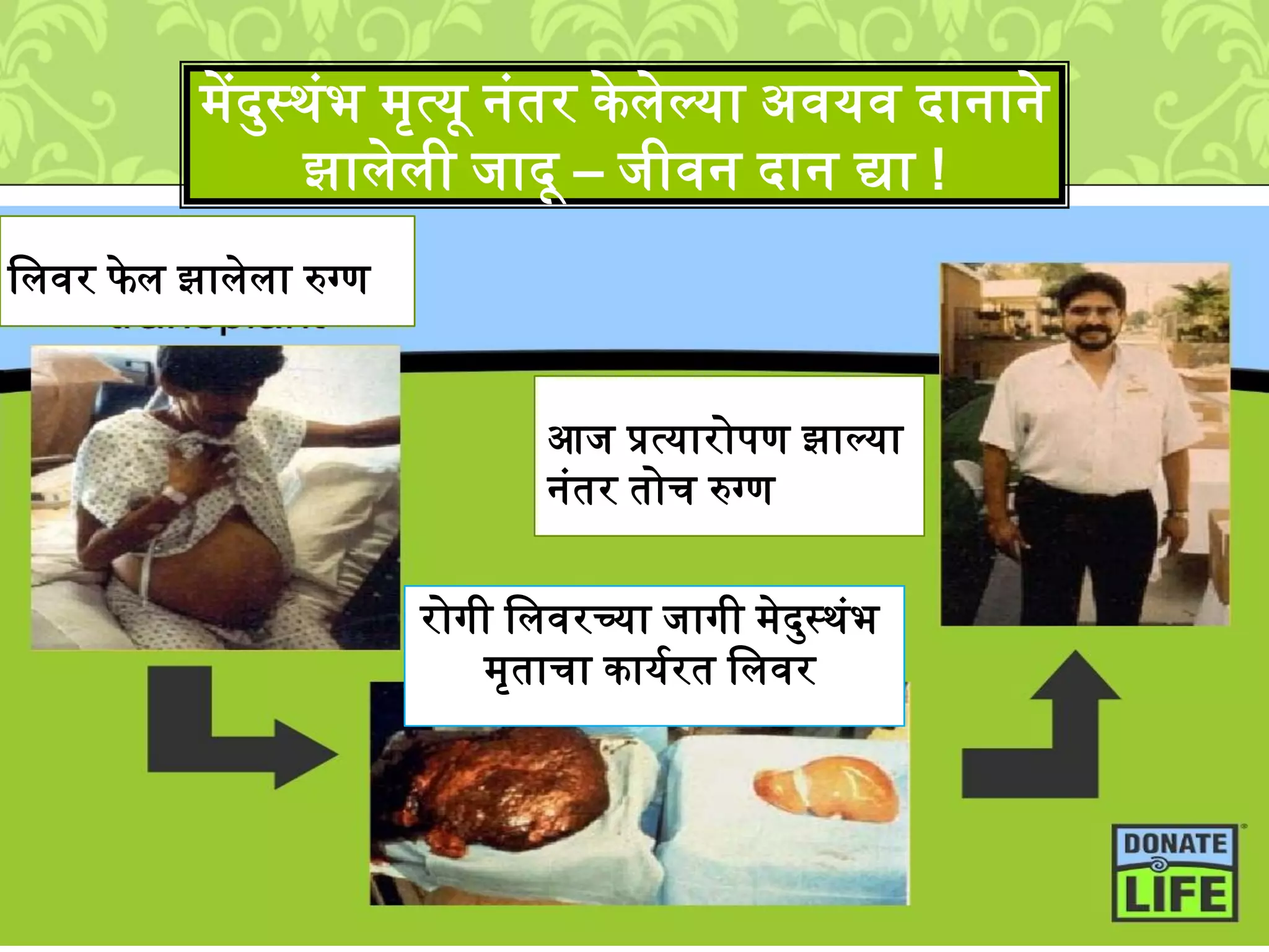 ्ेंदमस्र्ुंभ ्ृत्यू नुंतर केिेल्या अवयव दानाने
झािेिी िादू – िीवन दान द्या !
कार्िक्षमलिवर फे ि झािेिा रुग्ण
रोगी लिवरच्या िागी ्ेदमस्र्ुंभ
्ृताचा कायशरत लिवर
आि प्रत्यारोपण झाल्या
नुंतर तोच रुग्ण