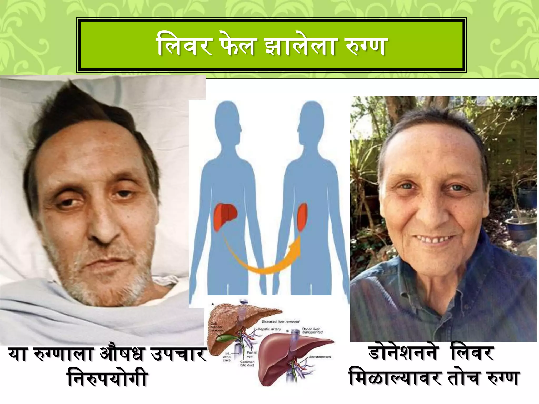 लिवर फे ि झािेिा रुग्ण
या रुग्णािा औिध उपचार
लनरुपयोगी
डोनेिनने लिवर
ल्ळाल्यावर तोच रुग्ण