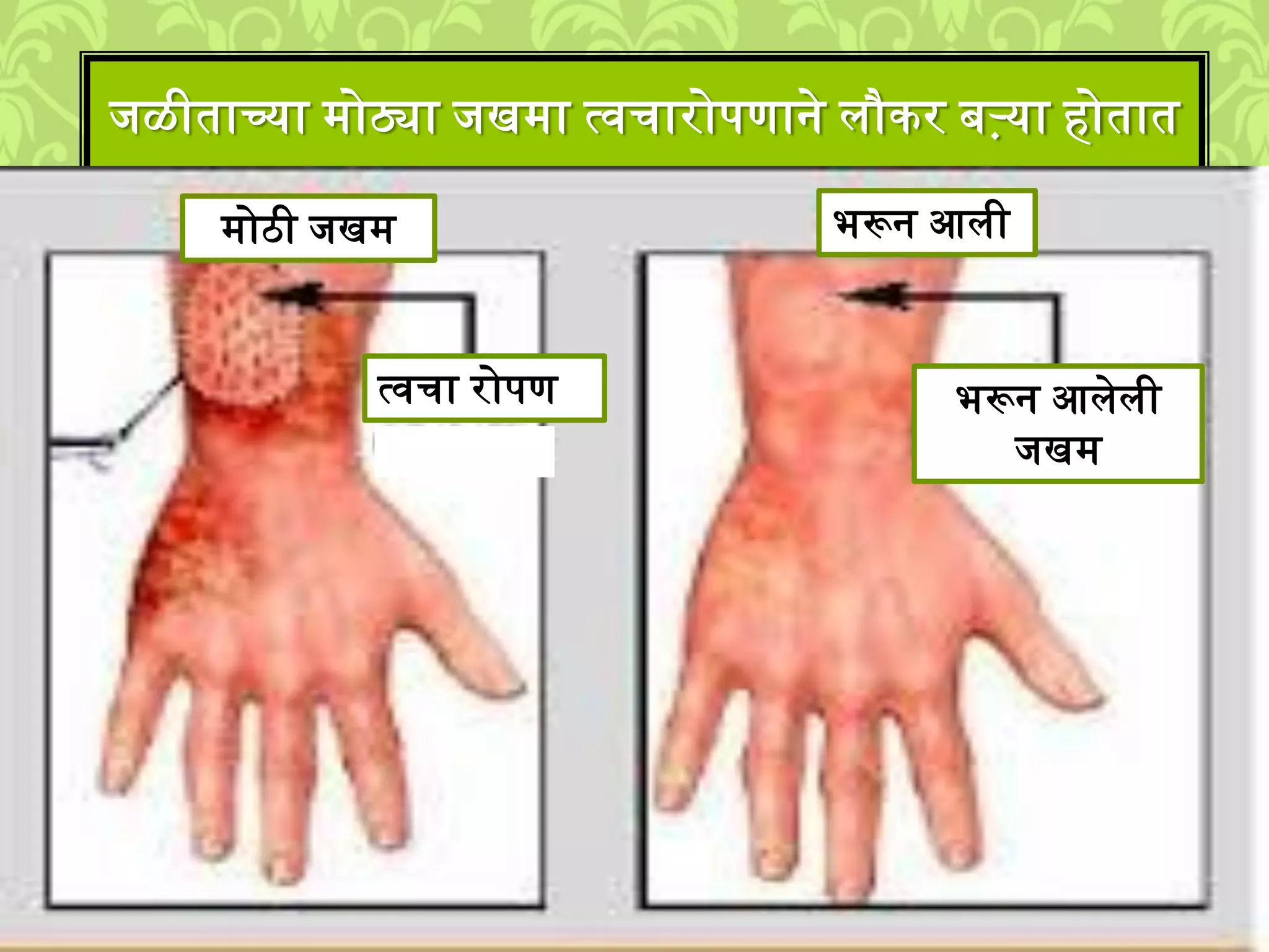 िळीताच्या ्ोठ्या िख्ा त्वचारोपणाने िौकर बऱ्या होतात
्ोठी िख् भरून आिी
त्वचा रोपण भरून आिेिी
िख्