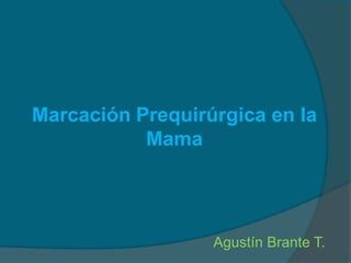 Marcación Prequirúrgica en la Mama Agustín Brante T. 