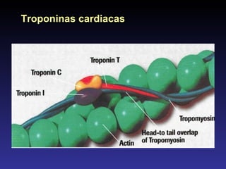 Troponinas cardiacas 