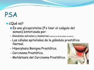 PSA
⚫ ¿Qué es?
⚫ Es una glicoproteína (Fx lisar el coágulo del
semen) sintetizada por:
- Glandulas salivales y mamarias (valores no detectables en suero)
- Las células epiteliales de la glándula prostática
Normal.
- Hiperplasia Benigna Prostática.
- Carcinoma Prostático.
- Metástasis del Carcinoma Prostático.
 