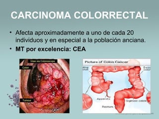 CARCINOMA COLORRECTAL
• Afecta aproximadamente a uno de cada 20
individuos y en especial a la población anciana.
• MT por excelencia: CEA
 