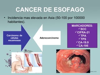CANCER DE ESOFAGO
• Incidencia mas elevada en Asia (50-100 por 100000
habitantes).
MARCADORES:
SCC
CIFRA-21
TPA
TPS
CA-19.9
CA-195
 