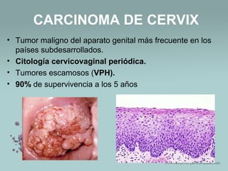 CARCINOMA DE CERVIX
• Tumor maligno del aparato genital más frecuente en los
países subdesarrollados.
• Citología cervicovaginal periódica.
• Tumores escamosos (VPH).
• 90% de supervivencia a los 5 años
 