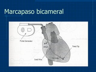 Marcapaso bicameral 