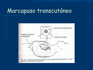 Marcapaso transcutáneo 