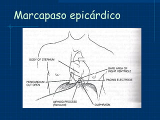 Marcapaso epicárdico 