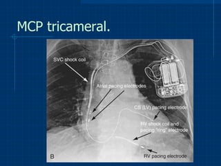 MCP tricameral. 