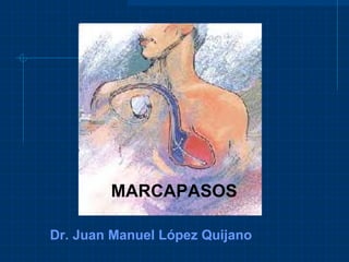 MARCAPASOS Dr. Juan Manuel López Quijano 