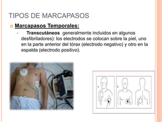 TIPOS DE MARCAPASOS
 Marcapasos Temporales:
 Transcutáneos generalmente incluidos en algunos
desfibriladores): los electrodos se colocan sobre la piel, uno
en la parte anterior del tórax (electrodo negativo) y otro en la
espalda (electrodo positivo).
 