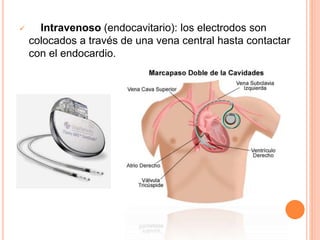  Intravenoso (endocavitario): los electrodos son
colocados a través de una vena central hasta contactar
con el endocardio.
 