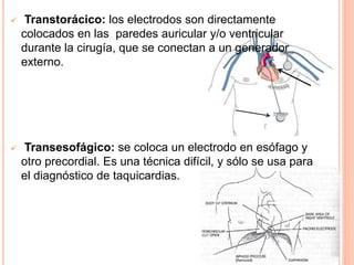  Transtorácico: los electrodos son directamente
colocados en las paredes auricular y/o ventricular
durante la cirugía, que se conectan a un generador
externo.
 Transesofágico: se coloca un electrodo en esófago y
otro precordial. Es una técnica difícil, y sólo se usa para
el diagnóstico de taquicardias.
 