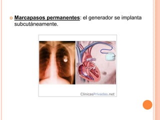  Marcapasos permanentes: el generador se implanta
subcutáneamente.
 