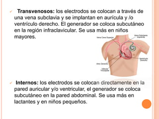  Transvenosos: los electrodos se colocan a través de
una vena subclavia y se implantan en aurícula y /o
ventrículo derecho. El generador se coloca subcutáneo
en la región infraclavicular. Se usa más en niños
mayores.
 Internos: los electrodos se colocan directamente en la
pared auricular y/o ventricular, el generador se coloca
subcutáneo en la pared abdominal. Se usa más en
lactantes y en niños pequeños.
 