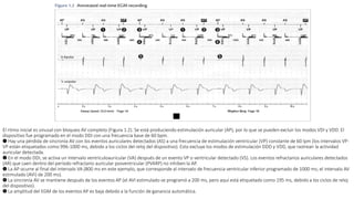 El ritmo inicial es sinusal con bloqueo AV completo (Figura 1.2). Se está produciendo estimulación auricular (AP), por lo que se pueden excluir los modos VDI y VDD. El
dispositivo fue programado en el modo DDI con una frecuencia base de 60 bpm.
➊ Hay una pérdida de sincronía AV con los eventos auriculares detectados (AS) a una frecuencia de estimulación ventricular (VP) constante de 60 lpm (los intervalos VP-
VP están etiquetados como 996-1000 ms, debido a los ciclos del reloj del dispositivo). Esto excluye los modos de estimulación DDD y VDD, que rastrean la actividad
auricular detectada.
➋ En el modo DDI, se activa un intervalo ventriculoauricular (VA) después de un evento VP o ventricular detectado (VS). Los eventos refractarios auriculares detectados
(AR) que caen dentro del período refractario auricular posventricular (PVARP) no inhiben la AP.
➌ La AP ocurre al final del intervalo VA (800 ms en este ejemplo, que corresponde al intervalo de frecuencia ventricular inferior programado de 1000 ms; el intervalo AV
estimulado (AVI) de 200 ms).
➍ La sincronía AV se mantiene después de los eventos AP (el AVI estimulado se programó a 200 ms, pero aquí está etiquetado como 195 ms, debido a los ciclos de reloj
del dispositivo).
➎ La amplitud del EGM de los eventos AP es baja debido a la función de ganancia automática.
 