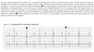 Los picos de estimulación de la Figura 2.2 se producen exactamente a 60 lpm (la frecuencia inicial), y todos los picos muestran
infradetección ventricular y falta de captura. Esto no debe confundirse con la falta de estimulación, que se refiere a la falta de
entrega de un pico de estimulación donde se esperaba.➊ Este latido podría interpretarse como un funcionamiento normal del
dispositivo con pseudofusión, ya que el pico se produce casi simultáneamente con el complejo QRS. Con pseudofusión, la
estimulación El pico se produce al inicio del QRS o poco después, pero antes de que el frente de onda de despolarización haya
alcanzado el dipolo principal. El pico de estimulación se produce durante el período refractario del miocardio y, por tanto, no
captura el ventrículo.➋ El pico ventricular se produce en la onda T, lo que puede ser potencialmente proarrítmico, pero no es el
caso aquí, ya que no hay captura.
 