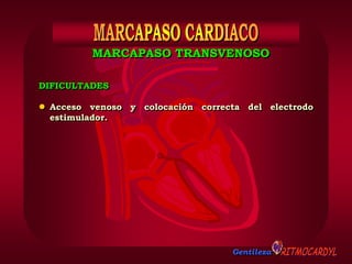 Gentileza
DIFICULTADES
 Acceso venoso y colocación correcta del electrodo
estimulador.
MARCAPASO TRANSVENOSO
 