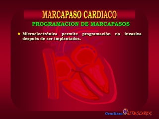 Gentileza
PROGRAMACION DE MARCAPASOS
 Microelectrónica permite programación no invasiva
después de ser implantados.
 