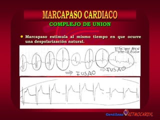 Gentileza
 Marcapaso estimula al mismo tiempo en que ocurre
una despolarización natural.
COMPLEJO DE UNION
 