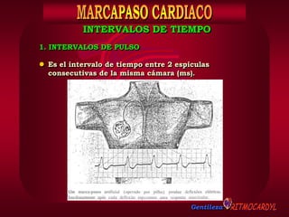 Gentileza
1. INTERVALOS DE PULSO
 Es el intervalo de tiempo entre 2 espiculas
consecutivas de la misma cámara (ms).
INTERVALOS DE TIEMPO
 