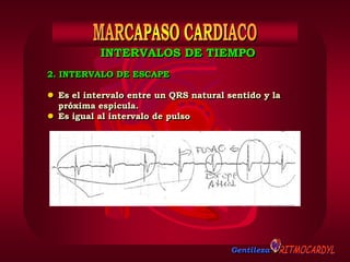 Gentileza
2. INTERVALO DE ESCAPE
 Es el intervalo entre un QRS natural sentido y la
próxima espicula.
 Es igual al intervalo de pulso
INTERVALOS DE TIEMPO
 