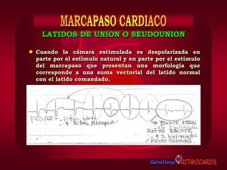 Gentileza
 Cuando la cámara estimulada es despolarizada en
parte por el estímulo natural y en parte por el estímulo
del marcapaso que presentan una morfología que
corresponde a una suma vectorial del latido normal
con el latido comandado.
LATIDOS DE UNION O SEUDOUNION
 