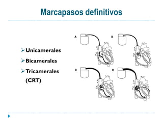 Marcapasos definitivos



Unicamerales
Bicamerales
Tricamerales
 (CRT)
 