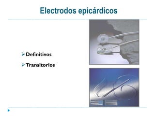 Electrodos epicárdicos



Definitivos
Transitorios
 