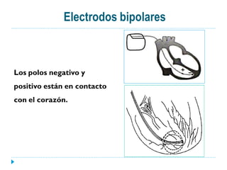 Electrodos bipolares



Los polos negativo y
positivo están en contacto
con el corazón.
 