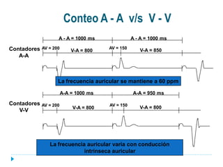 Conteo A - A v/s V - V
                    A - A = 1000 ms                A - A = 1000 ms

Contadores   AV = 200                   AV = 150
                            V-A = 800                 V-A = 850
   A-A



                    La frecuencia auricular se mantiene a 60 ppm

                        A-A = 1000 ms              A-A = 950 ms

Contadores AV = 200                     AV = 150
                            V-A = 800                 V-A = 800
   V-V




                La frecuencia auricular varia con conducción
                             intrínseca auricular
 