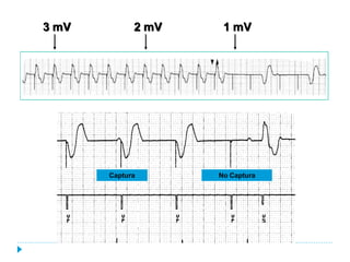3 mV         2 mV    1 mV




       Captura      No Captura
 