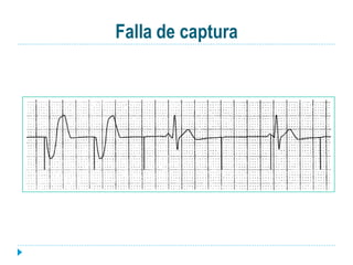 Falla de captura
 